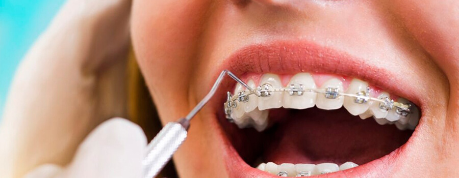 El Hilo Dental y la Importancia de la Higiene Oral Preventiva, OrtoDental, Ortodoncista en México CDMX